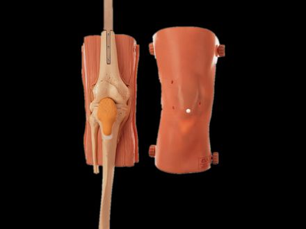 Knee joint arthroscopy