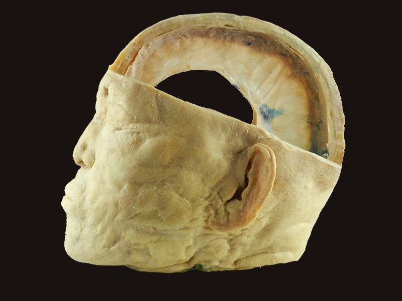 Brain with dura medical specimen