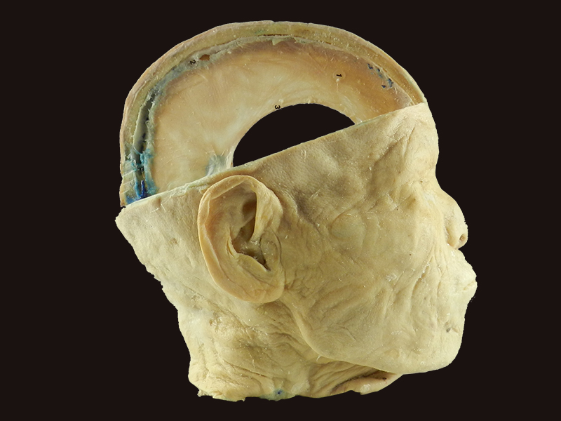 Brain with dura plastinated specimen