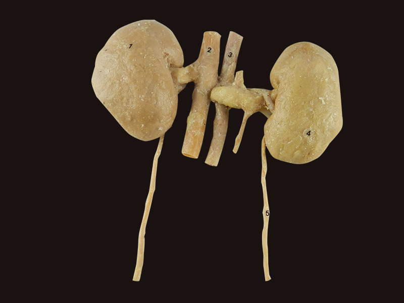 double kidney specimen