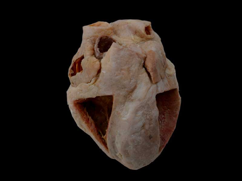 Heart specimen with ventricles opened to expose the valves