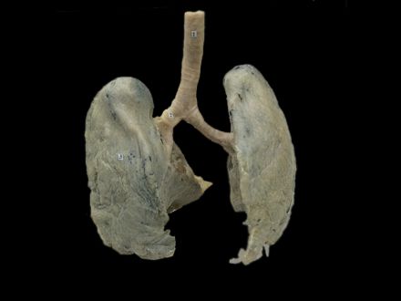 Double lungs plastinated specimens (von hagens plastination  )