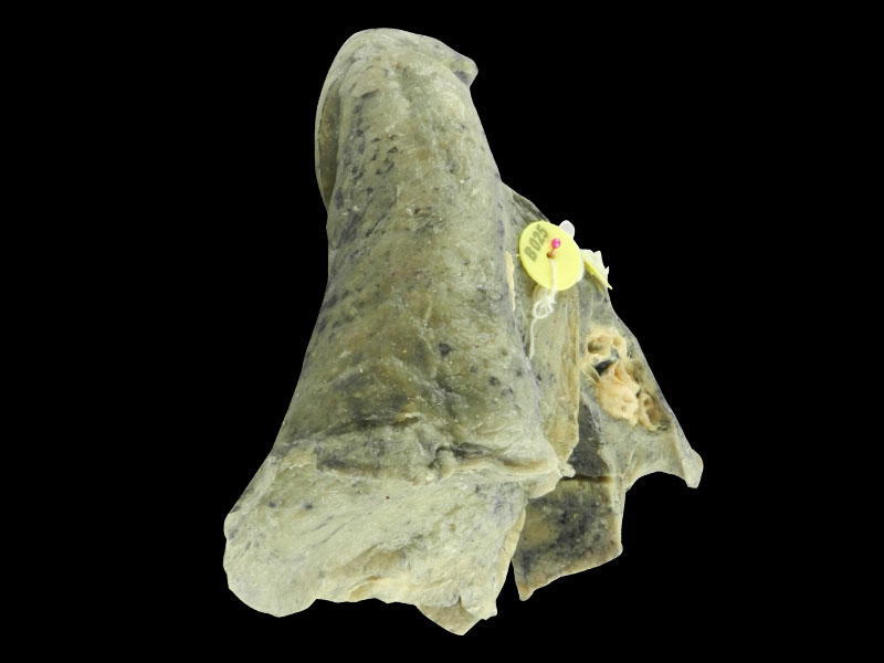 Root of the lung medical specimen