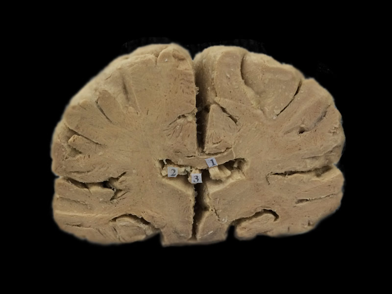 Coronal section of brain plastinated specimens,anatomy model,anatomy