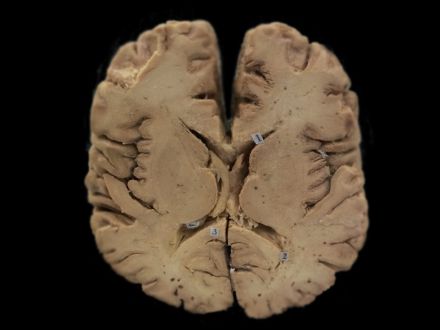 Horizontal section of brain through internal capsule plastinated specimens