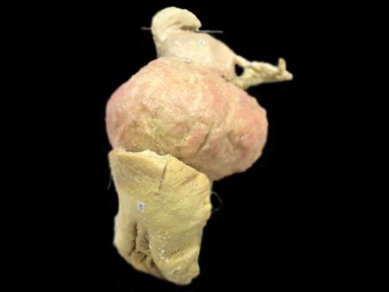 Female genitalia - (in vitro) plastinated specimens 