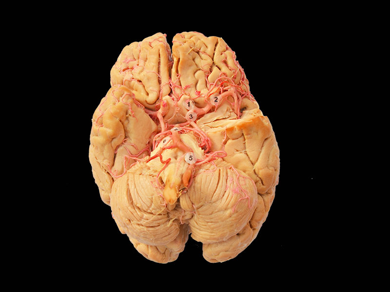 Plastinated arteries of base of the brain