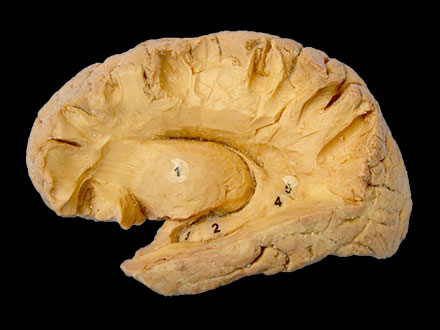Plastinated hippocampal formation