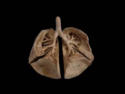 Plastination Segmental of Bronchi