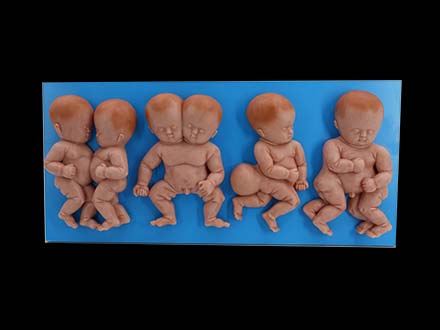 Deformed Fetus Simulation Model