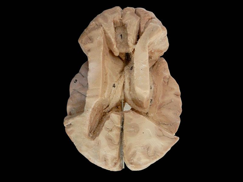 Plastinated insula