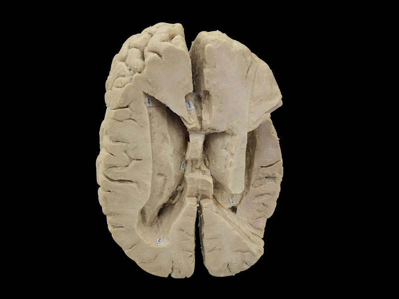 Plastination insula