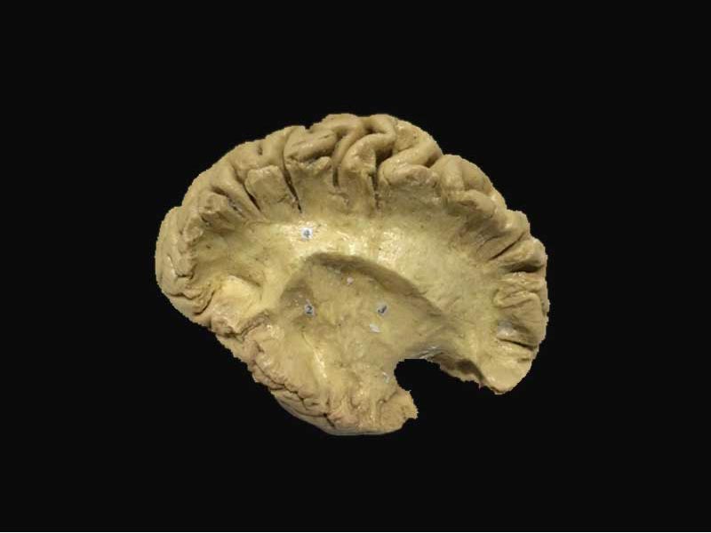 association fiber of brain  plastinated specimens