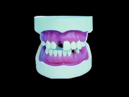 Dental implant operation model