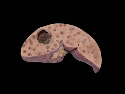 Bile Duct Epithelial Liver Cancer Model