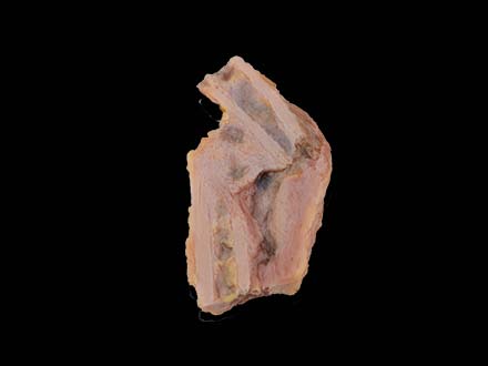Bone Disease Formation Model