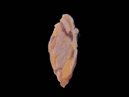 female breast cancer model