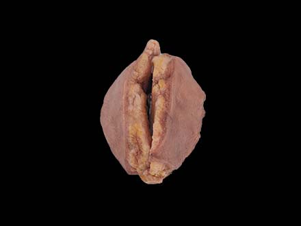 Breast Cancer Model