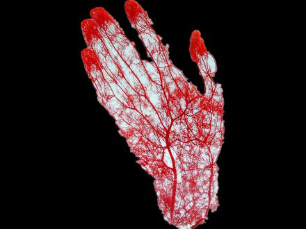 Hand artery casting specimens