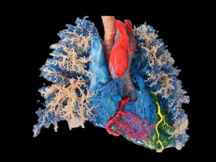 Heart -lung vascular casting specimens