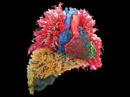 Heart liver and lung casting specimens