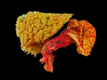Liver pancreas spleen and duodenum casting specimens