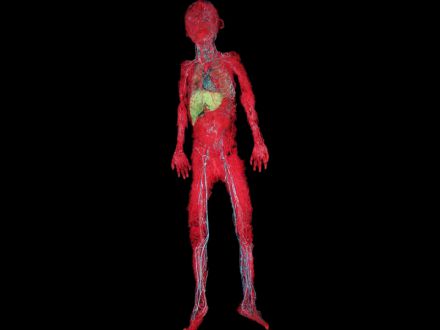 Systemic vascular casting specimens