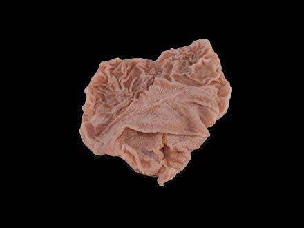Duodenal Ulcer Model