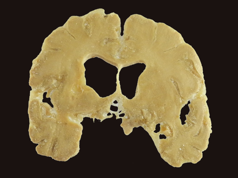 coronal section of brain medical specimen