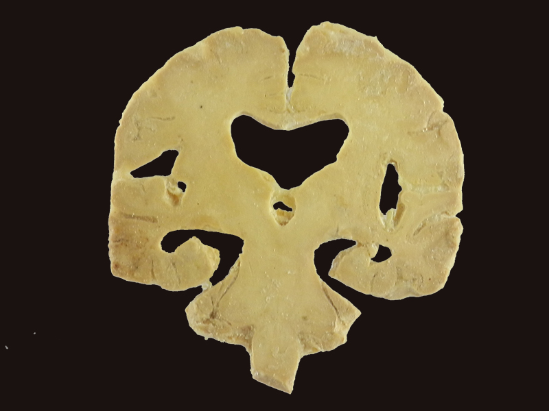 coronal section of brain plastinated specimen