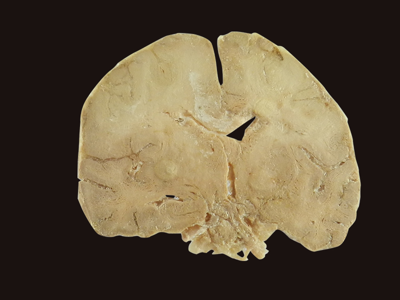 coronal section of brain plastination
