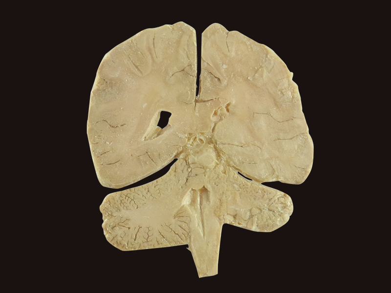 coronal section of brain specimen