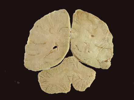 coronal section of brain