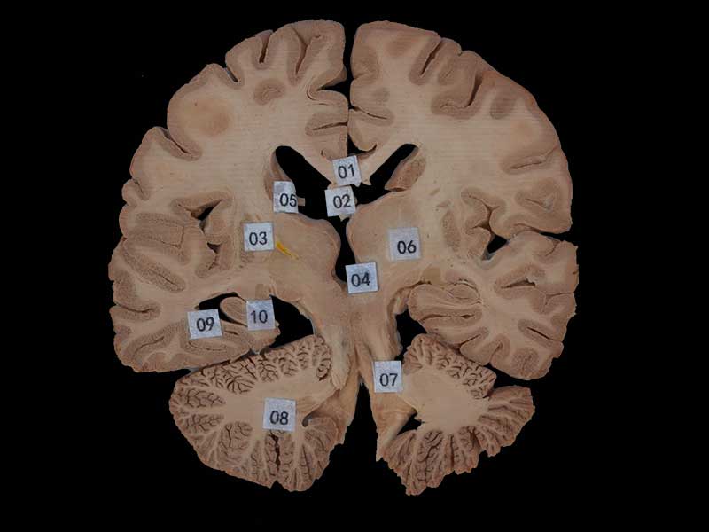 coronal section of head specimen plastination