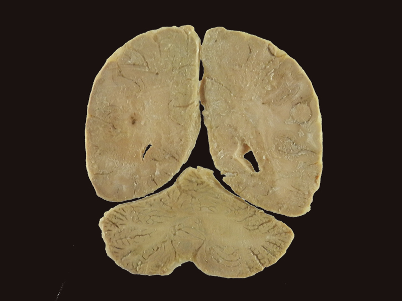 coronal section of human brain