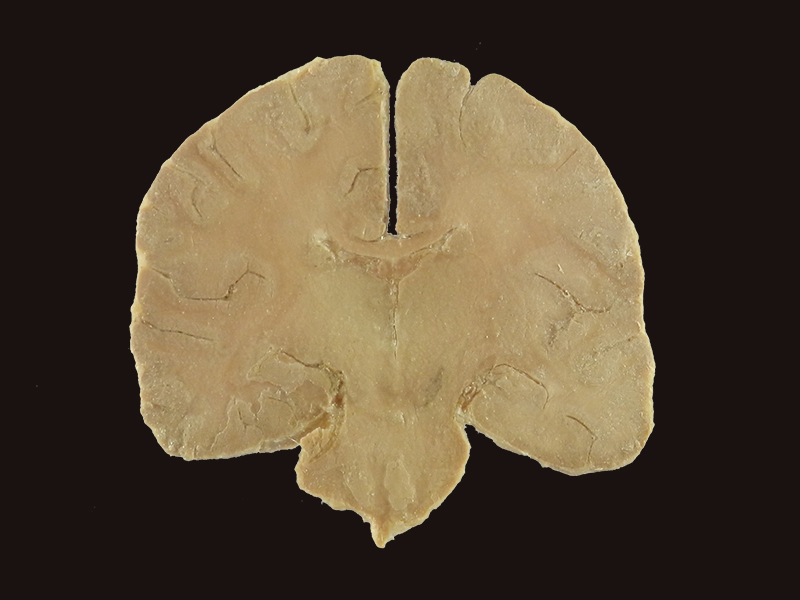 coronal section of human brain plastinated specimen