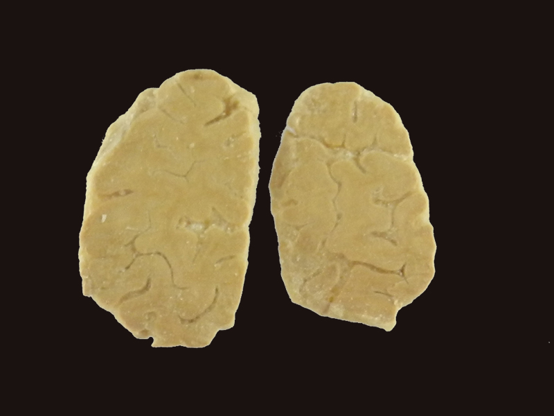 coronal section of human brain specimen