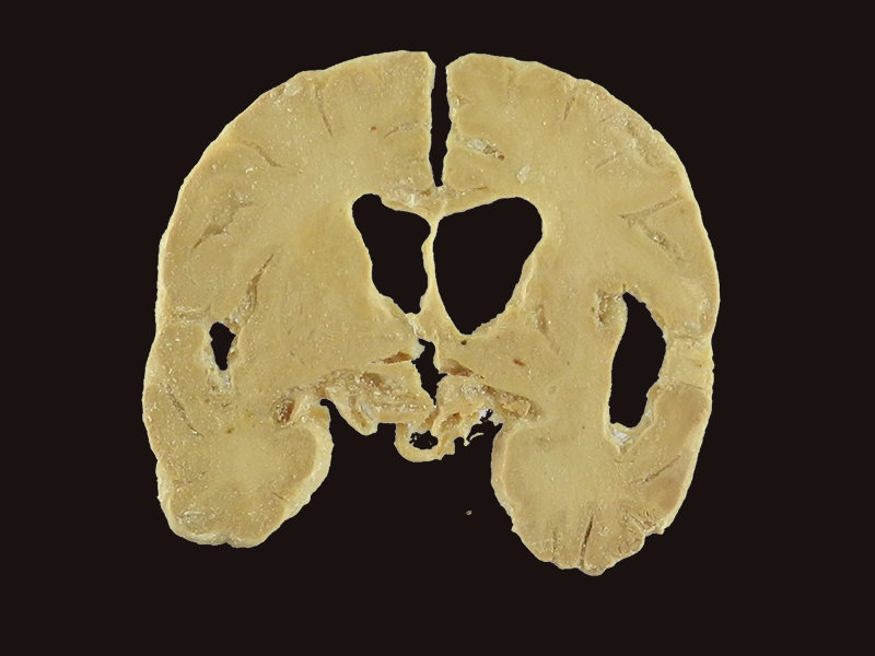 coronal section of human brain