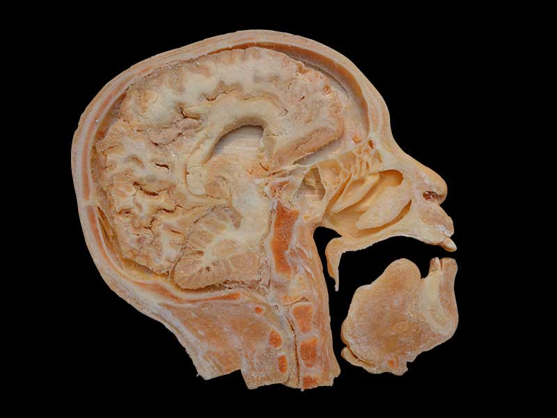 sagittal section of head plastination