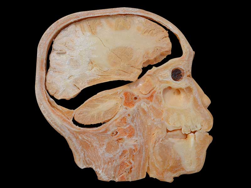 sagittal section of head specimen