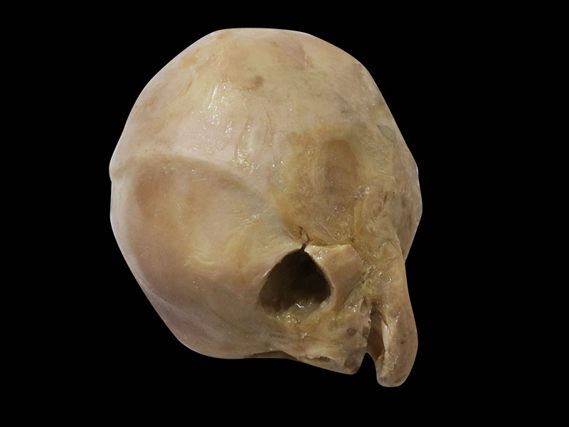 fetal skull