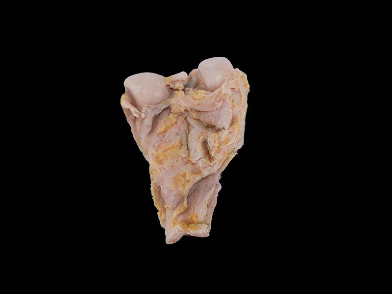 High Simulation Osteosarcoma Model