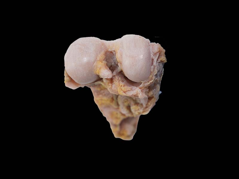 High Simulation Silicone Osteosarcoma Model