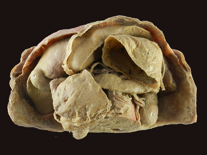 Abdominal viscera and caeliac trunk medical specimen