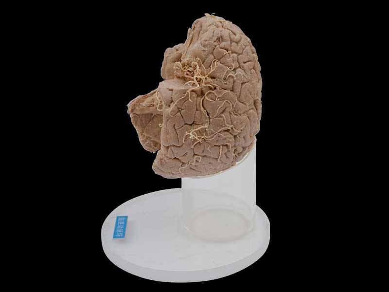 Arteries of base of brain plastination