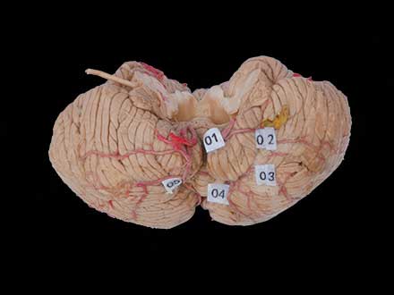 artery of cerebellum