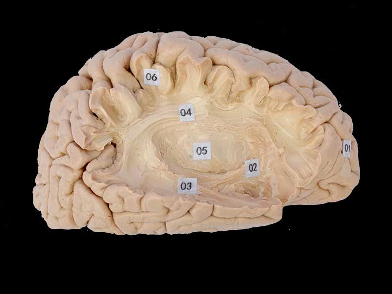 Association fiber of cerebral hemisphere