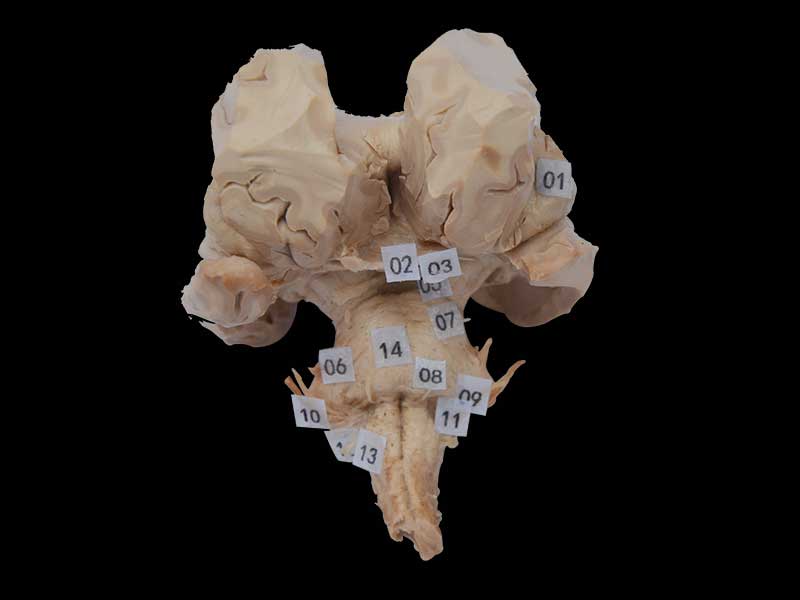 Brain stem plastination  with complete nerve root