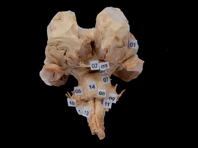 Brain stem with complete nerve root