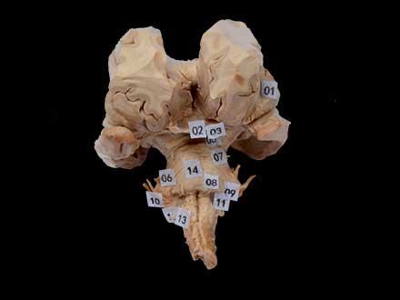 Brain stem with complete nerve root